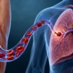 How Fast Does a Blood Clot Travel From the Leg To the Lungs