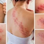 Images of Shingles Early Signs, Stages & Symptoms